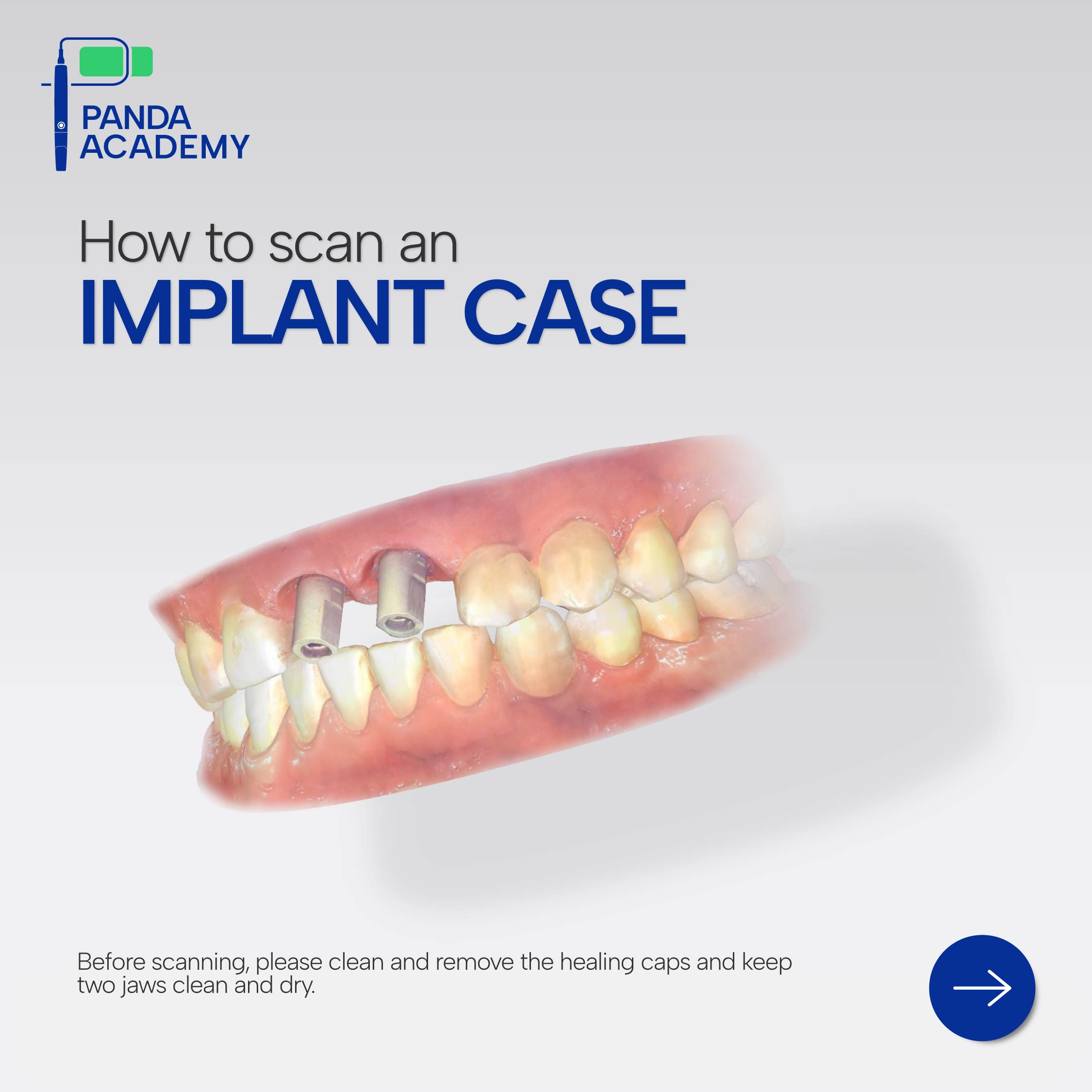 PANDA ACADEMY: How to Scan an Implant Case?
